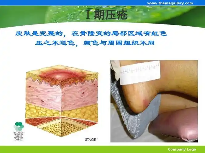临床医学 icu危重病人压疮的预防护理新进展ppt Ⅰ期压疮 皮肤是完整
