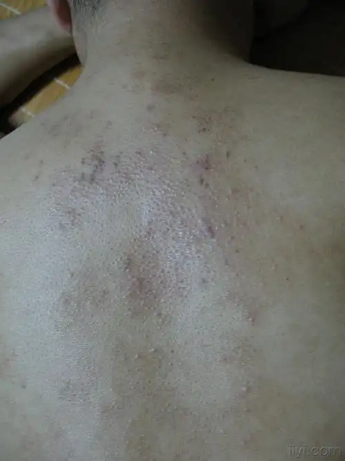 本人没有见过的背部皮肤病请大家出高见