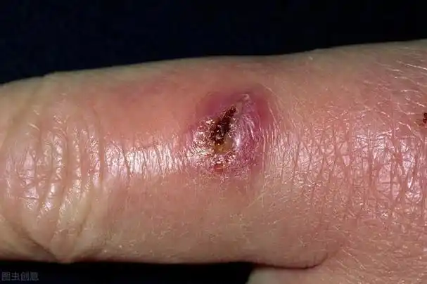 骨折伤口愈合后还会感染骨髓炎吗(骨折后外固定伤口处流脓)(2)