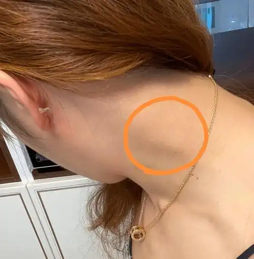 陈志耿医师颈淋巴结肿大疼痛对证即愈