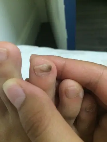 问:脚的一个中指的指甲上端一半是褐色的而且上半部分的指甲很厚 下半