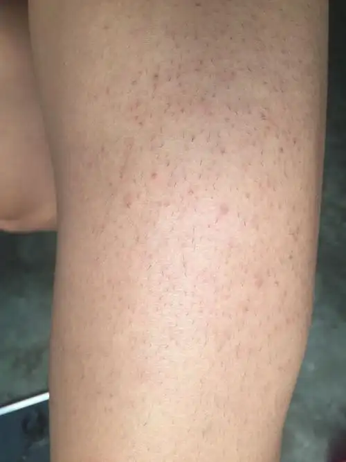 我是个男生,腿上长了好多的斑点 每个毛孔上都有一个 我这是怎么了