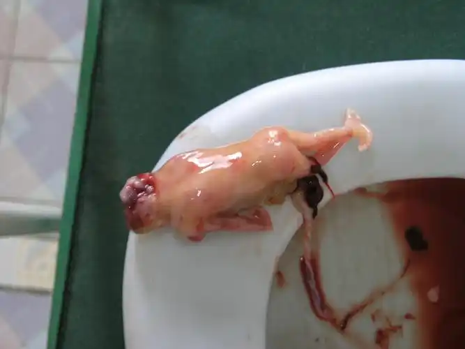 原创胎儿畸形无脑儿