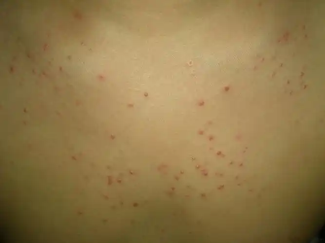 马拉色菌毛囊炎1例