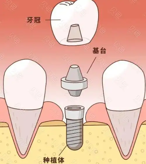 泰安种植牙医院排名分享,都是种牙技术好还便宜的牙科! - 贝色口腔