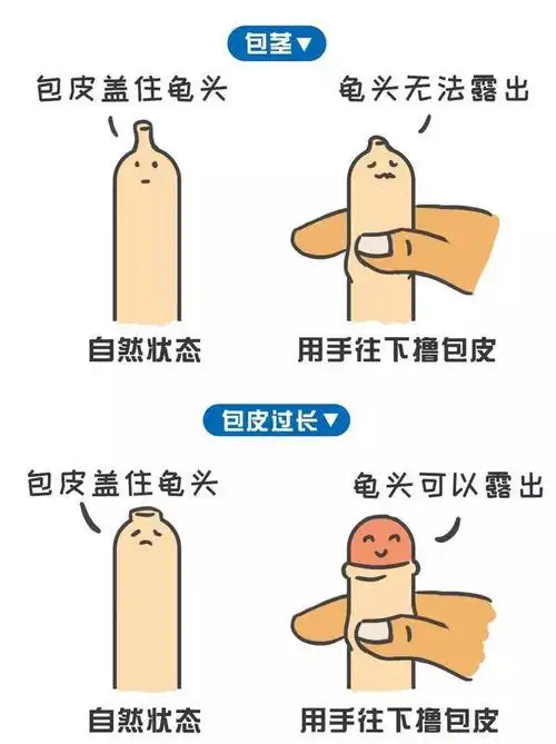 包皮过长,包茎家长需要知道的那些事_包皮过长_介绍_症状表现_治疗