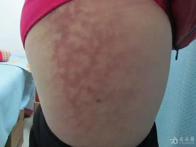 女士大腿根部的红斑——火激红斑 - 皮肤及性传播疾病讨论版 - 爱爱医