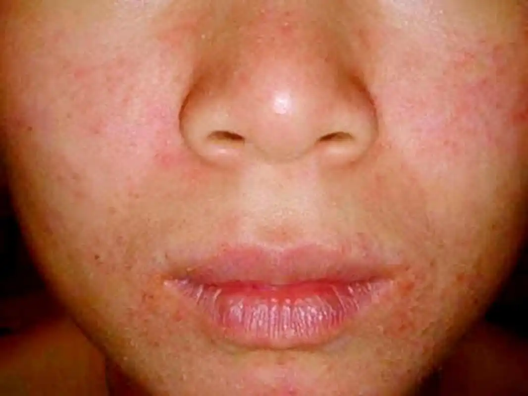 而成人型脂溢性皮炎,配合抗菌消炎药的治疗可在2周左右见效,病程较长