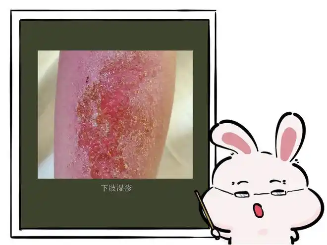 特应性皮炎,湿疹傻傻分不清_网易订阅