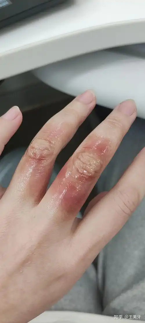 开水烫伤后的处理方式及全过程记录