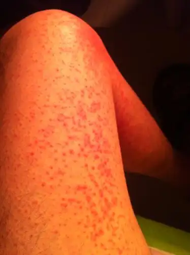 药物过敏了,身上全是红疙瘩怎么办?痒死