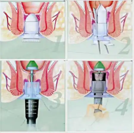 pph手术即吻合器痔上粘膜环切术,是1998年以来出现治疗痔疮的方法.