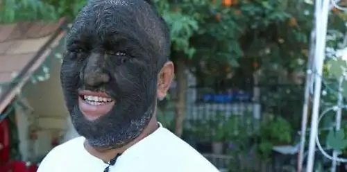 在美国加州,有一个叫拉里的人,被称世界上毛发最多的男人,和哪位最近