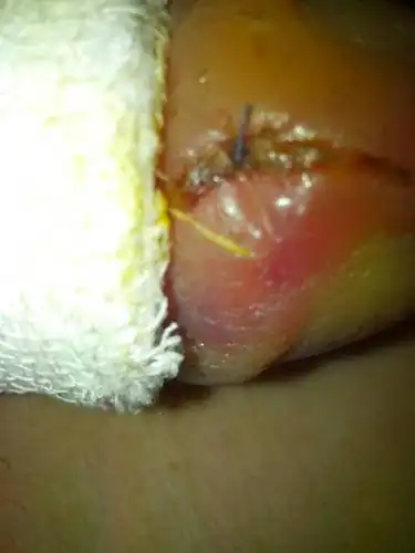 2014-03-22 方占和 医师 包皮系带手术…术后12天了…切口恢复很骸