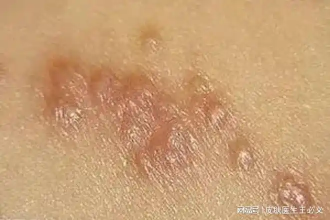 注意皮肤这两个异常表现,可能是疥疮|皮疹|瘙痒|疥虫|毛囊炎_网易订阅