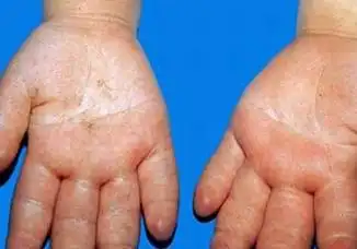 肾炎性水肿的中医治疗