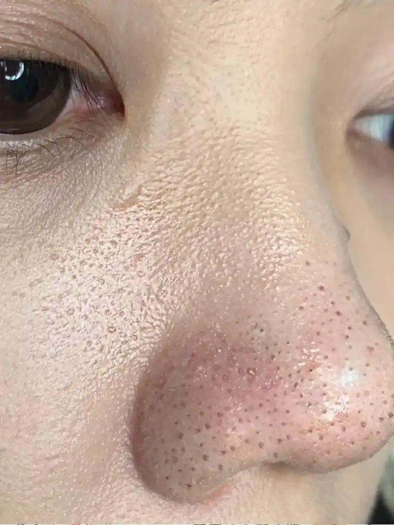 家人们,我敢素颜出门了!!!之前鼻子都是密密麻麻的黑头,反反 - 抖音