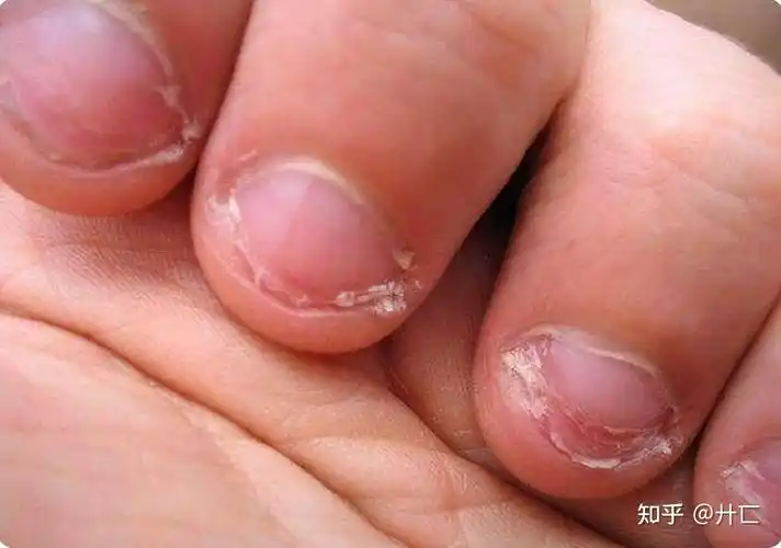02长期咬指甲的孩子,后来怎么样了?