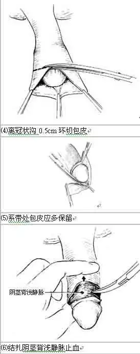 割包皮的过程是怎样的? - 匿名用户的回答 - 知乎