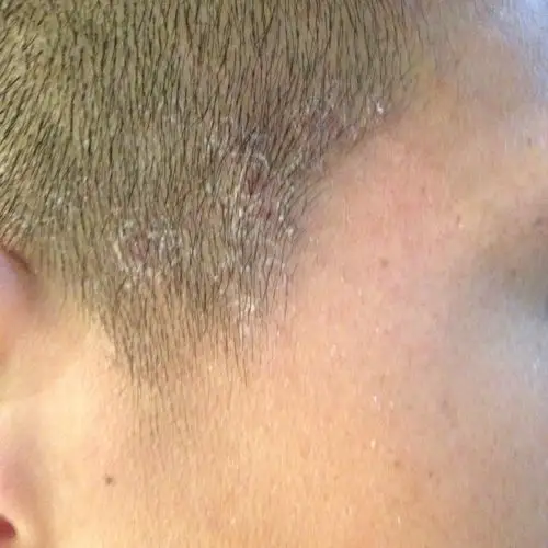 我的头皮屑是那种一块一块,手可以抠下来的,有时候不小心抠出