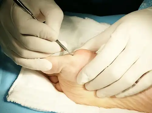 得了拇外翻怎么办