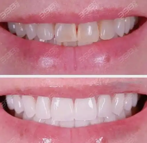 牙贴面案例对比