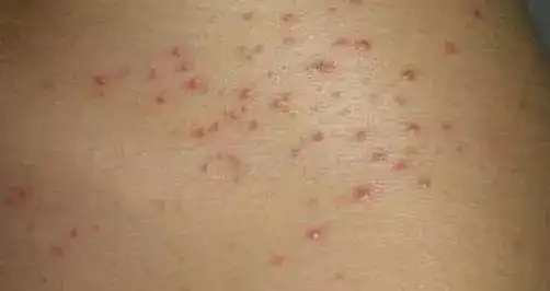 青春痘与毛囊炎,傻傻分不清!