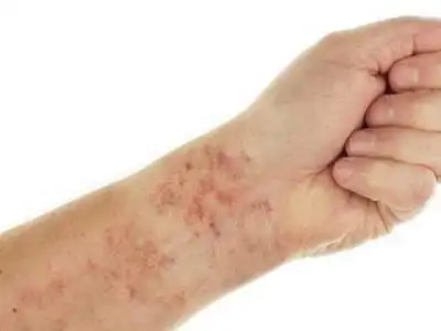 血栓性血小板减少性紫癜的症状和图片 - 有来医生