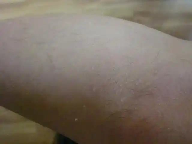 我腿上起皮是什么病