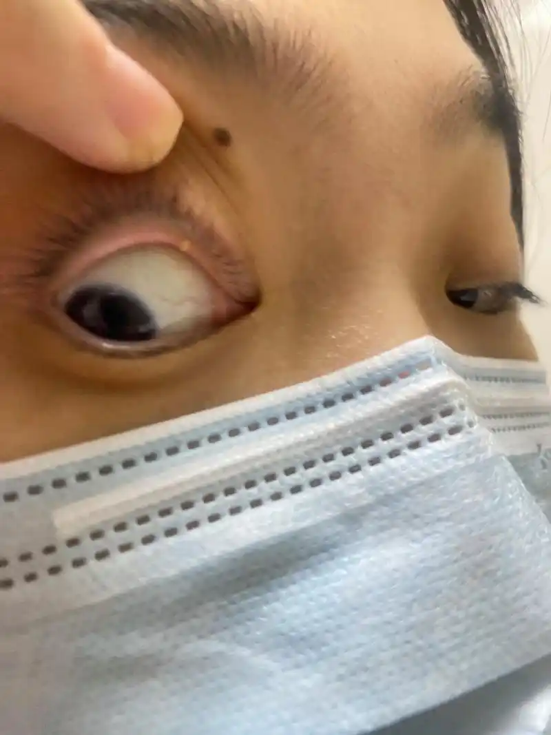 一边阳,一边又麦粒肿! 	 真是衰!