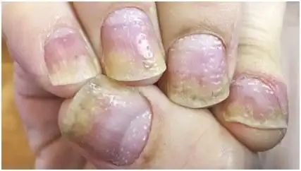 一定要注意了,这是指/趾炎,是银屑病关节炎的一种标志性的症状