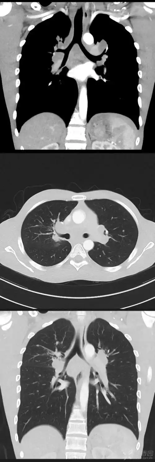 总在肺结核影像上「翻车」?老司机带带你