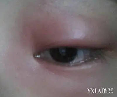 【图】睡觉起来眼睛肿是怎么回事 6大浮肿原因及消肿方法详解