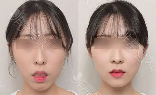 分享一组韩国长脸整容后效果图,长脸变短后变化居然这么大!-非常爱美