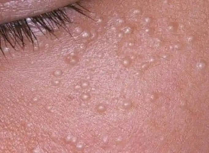 眼部下方扁平疣图片