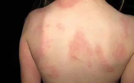 荨麻疹图片和症状是什么10个荨麻疹初期症状图片