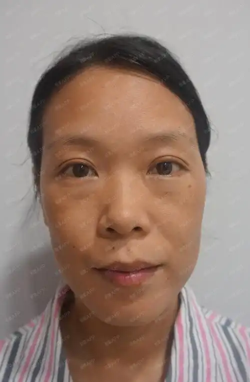 【张建强全脸脂肪填充案例】