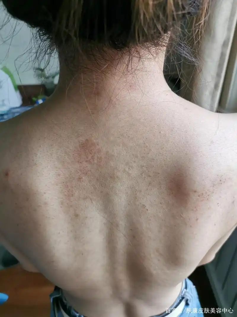 毛囊炎可以在不同部位爆发,位置很隐秘,经常被忽略掉!
