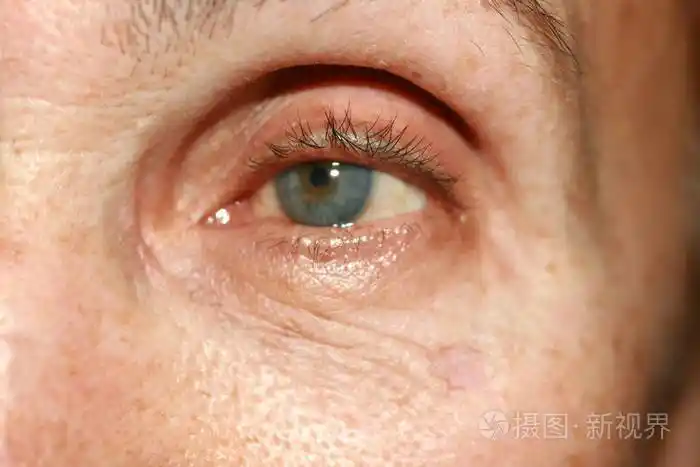 眼睛下面的皱纹脸上的皱纹眼睑松弛