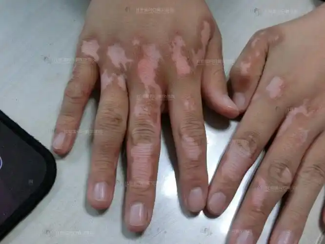 每个人的白癜风病情都是独一无二的,因此治疗方案也应因人而异.