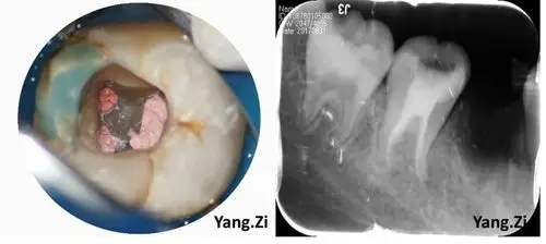 下颌第二磨牙c3型弯曲根管一例