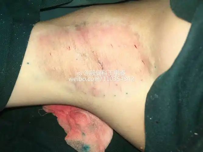腋臭微切口1厘米根除实例不容错过