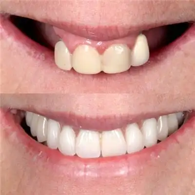 全口种植牙修复对比