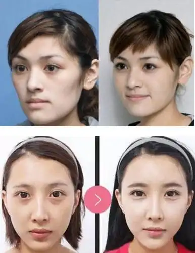 填充苹果肌,玻尿酸自体脂肪线雕那个好?