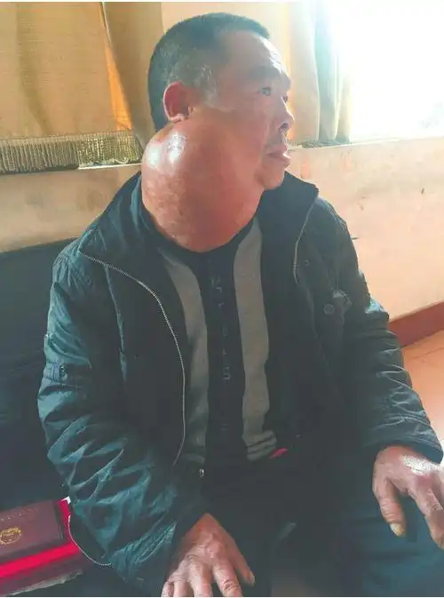 合川新闻 > 正文重庆市肿瘤医院诊断何怀联患上的是恶性淋巴瘤,不能动