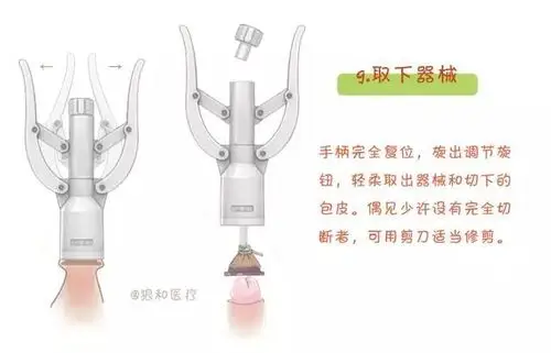 图解一次性包皮环切缝合器手术 - 好大夫在线