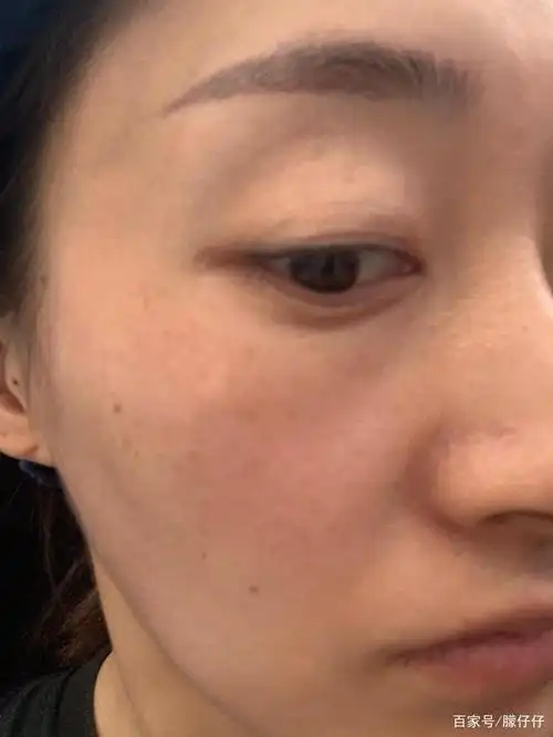 术前情况:皮肤干燥,缺水,斑点.