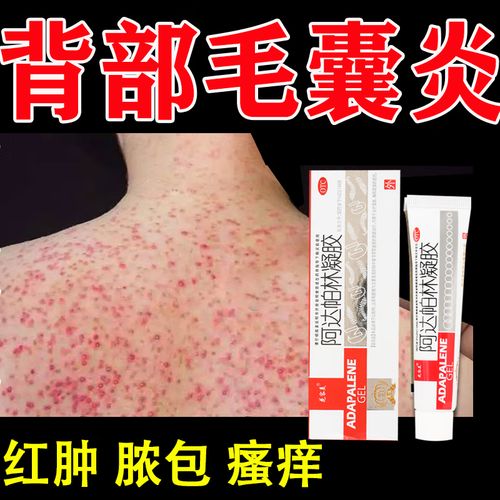 一盒装【背上长痘 痤疮】