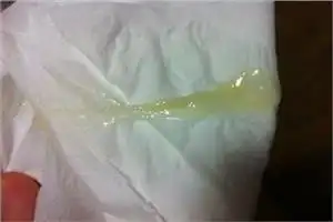 怀孕初期分泌物图片