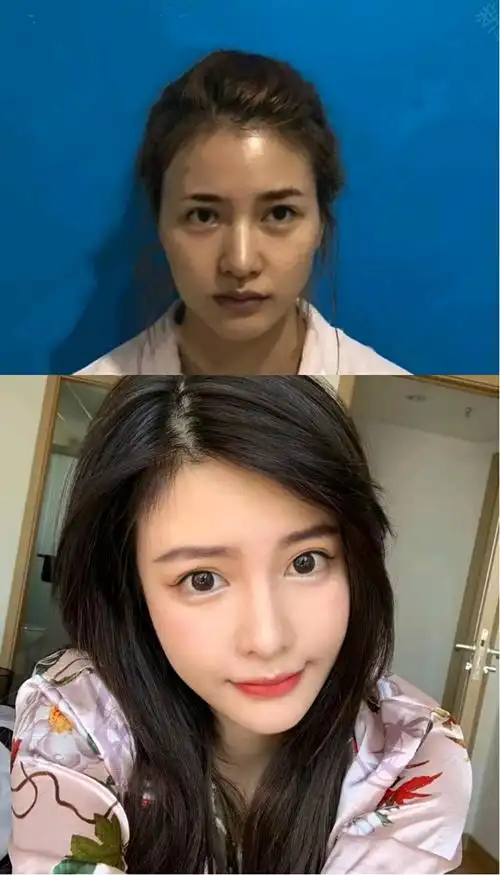 全面部脂肪填充2个月对比